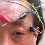 I've been taking a variety of acupuncture treatments for post herpetic neuralgia pain, including the more drastic 3-stim treatment.